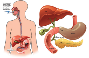 ERCP endoscopic procedure illustration
